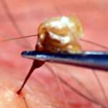 Honey Bee stinger Upclose picture of a stinger being removed with tweezers from a persons arm
